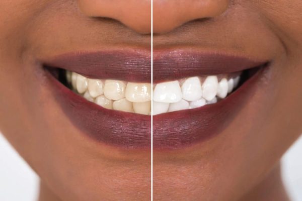 Teeth-Whitening