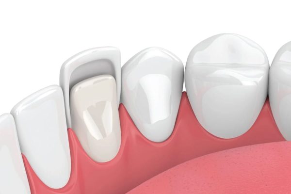 Veneers